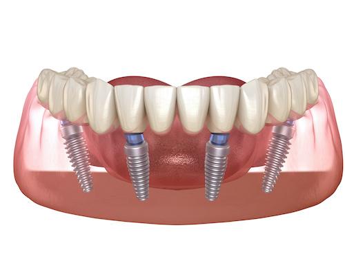 image of dental implants in coburg north