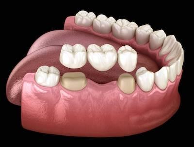 image of a dental bridge in coburg north
