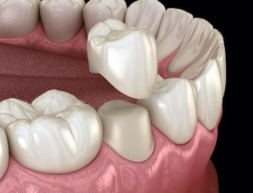 image of a dental crown in coburg north