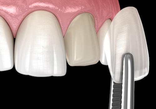 image of a dental veneer in coburg north