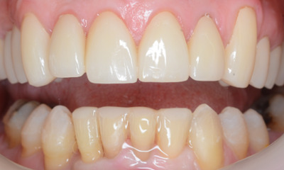 After treatment - Clear Aligners and Crowns/Veneers 