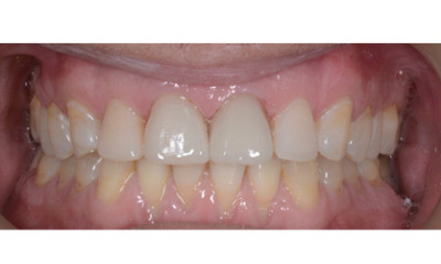 After treatment - Composite Veneers on Front Teeth
