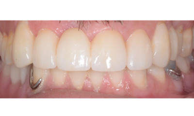 After treatment - Crowns/Veneers and Dentures