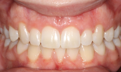 After treatment - Fixed Orthodontic Treatment