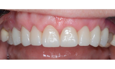 After treatment - Gum Lift, Crown and Veneers 