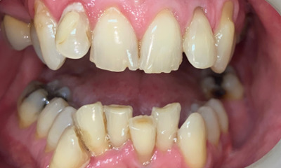 Before treatment - Clear Aligners and Crowns/Veneers 