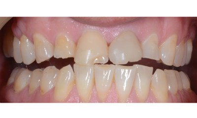 Before treatment - Composite Veneers on Front Teeth
