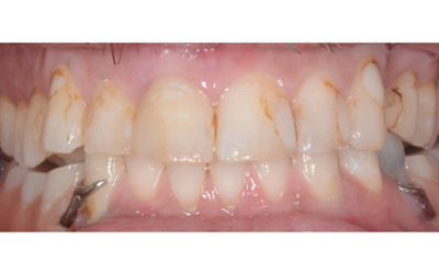 Before treatment - Crowns/Veneers and Dentures