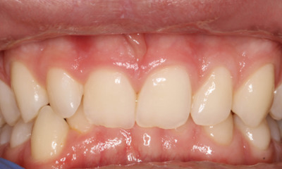 Before treatment - Fixed Orthodontic Treatment
