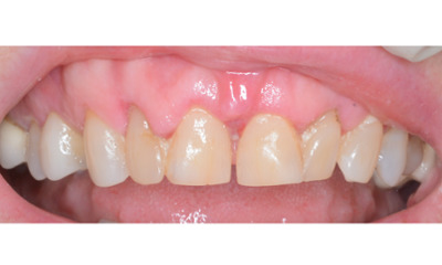 Before treatment - Gum Lift, Crown and Veneers 